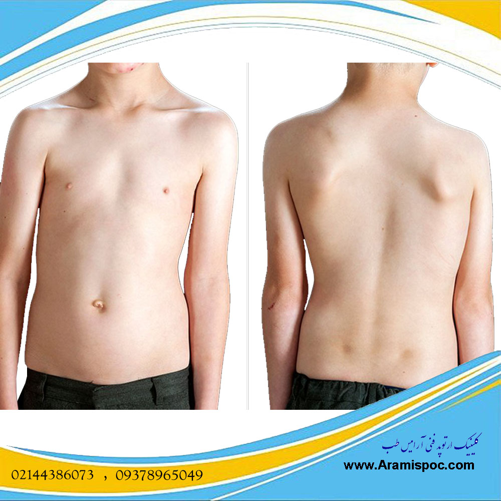 انحراف ستون فقرات در کودکان